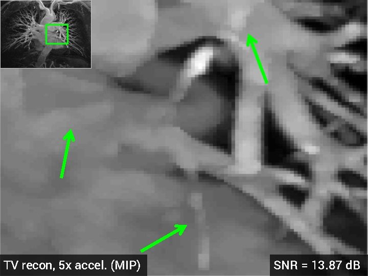 TV recon, 5 x accel. (MIP) SNR = 13. 87 d. B 