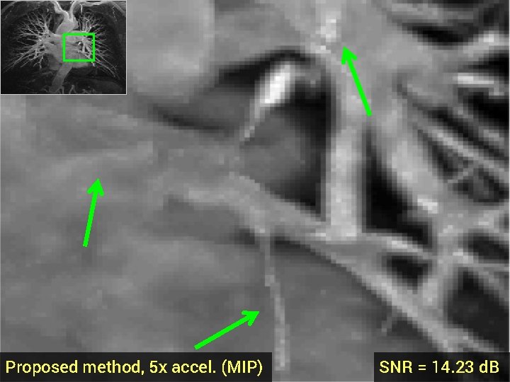 Proposed method, 5 x accel. (MIP) SNR = 14. 23 d. B 