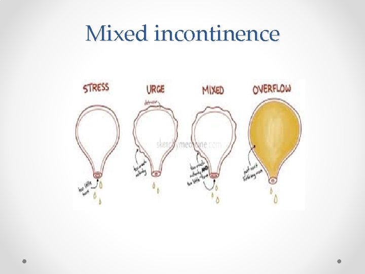 Multiple Incontinence Definition classification and triage of female UI Francesco