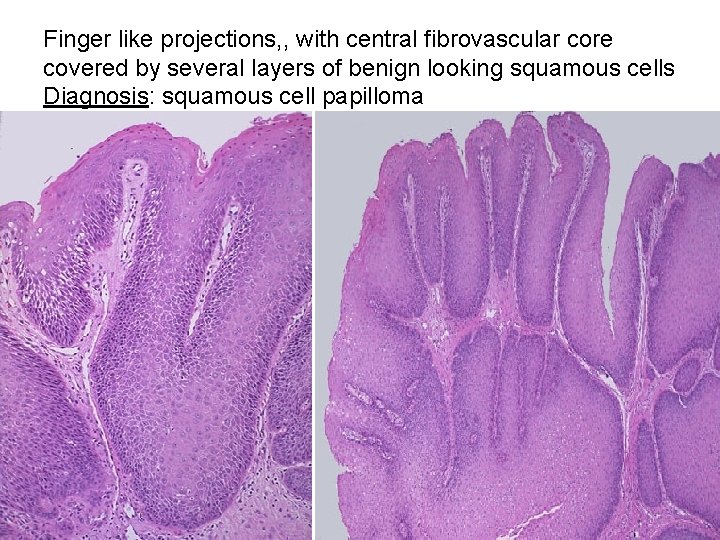 Finger like projections, , with central fibrovascular core covered by several layers of benign