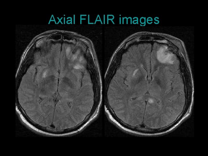 Axial FLAIR images 