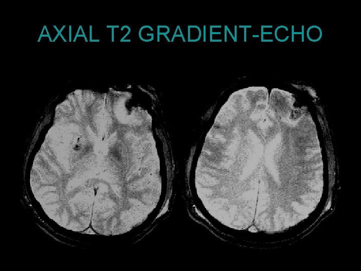 AXIAL T 2 GRADIENT-ECHO 