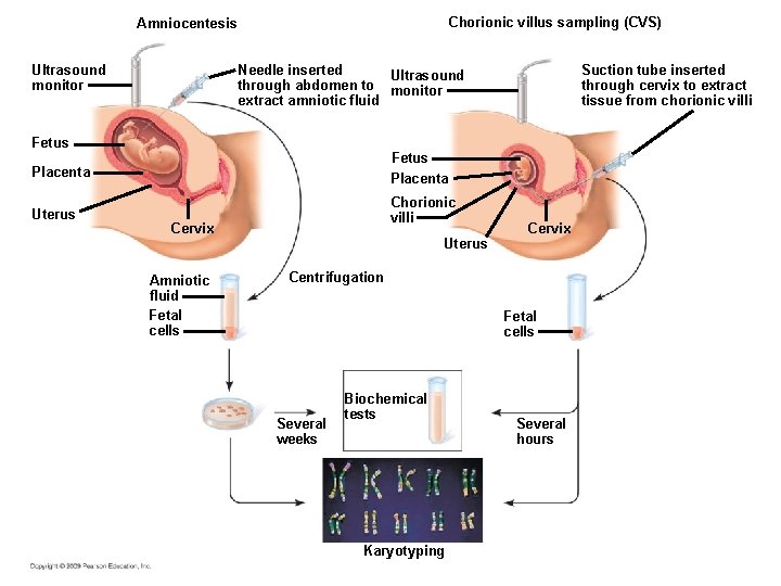 Chorionic villus sampling (CVS) Amniocentesis Needle inserted Ultrasound through abdomen to monitor extract amniotic