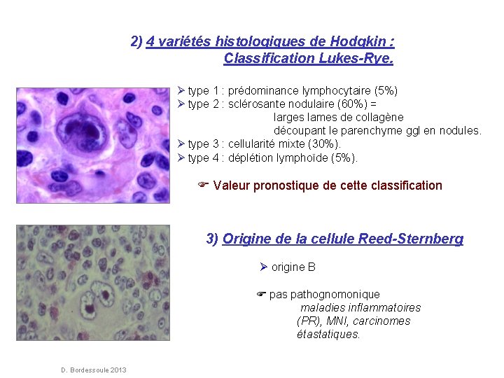 2) 4 variétés histologiques de Hodgkin : Classification Lukes-Rye. type 1 : prédominance lymphocytaire