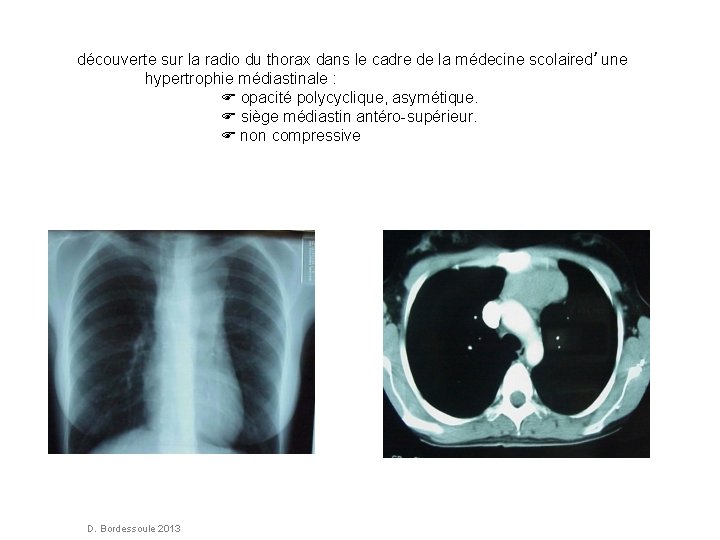 découverte sur la radio du thorax dans le cadre de la médecine scolaired’une hypertrophie