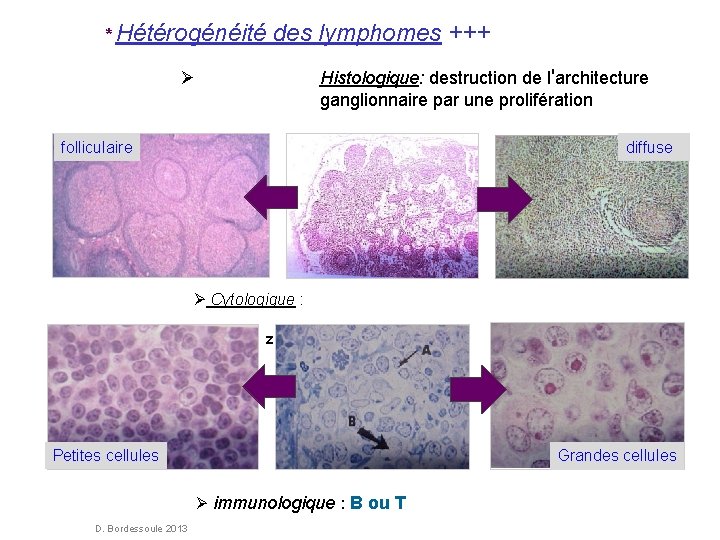 * Hétérogénéité des lymphomes +++ Histologique: destruction de l'architecture ganglionnaire par une prolifération folliculaire