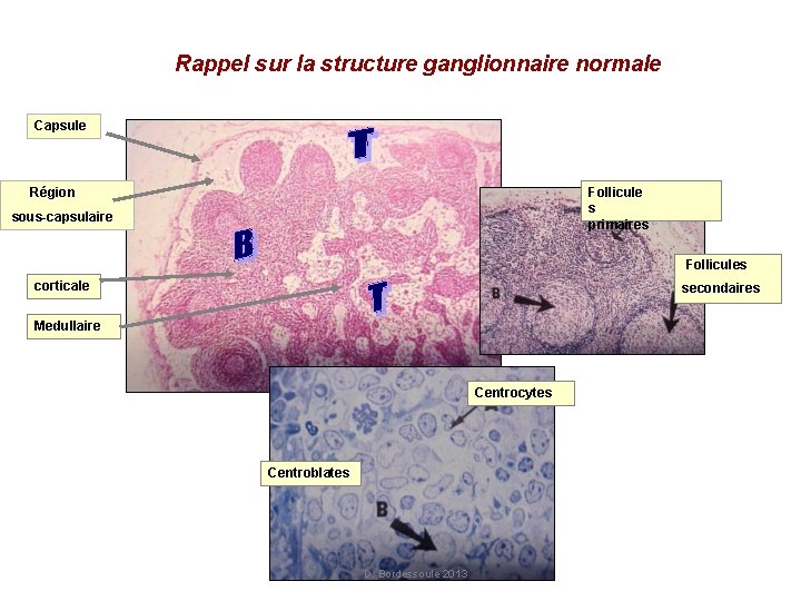 Rappel sur la structure ganglionnaire normale Capsule Région Follicule s primaires sous-capsulaire Follicules corticale