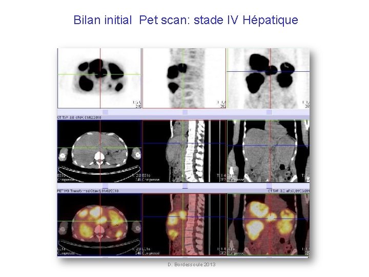 Bilan initial Pet scan: stade IV Hépatique FDG initial D. Bordessoule 2013 