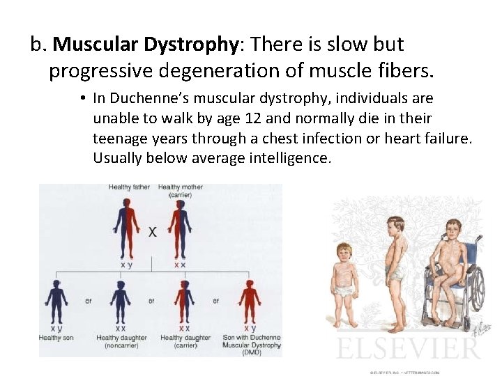 b. Muscular Dystrophy: There is slow but progressive degeneration of muscle fibers. • In