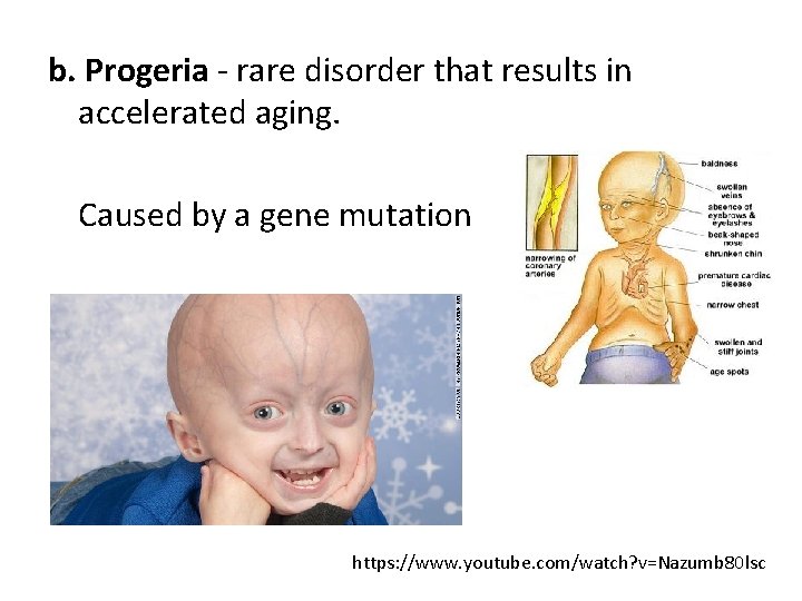 b. Progeria - rare disorder that results in accelerated aging. Caused by a gene