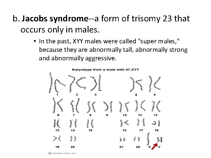 b. Jacobs syndrome--a form of trisomy 23 that occurs only in males. • In