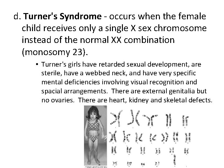 d. Turner's Syndrome - occurs when the female child receives only a single X