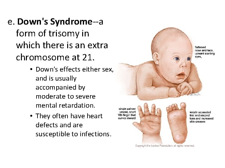 e. Down's Syndrome--a form of trisomy in which there is an extra chromosome at