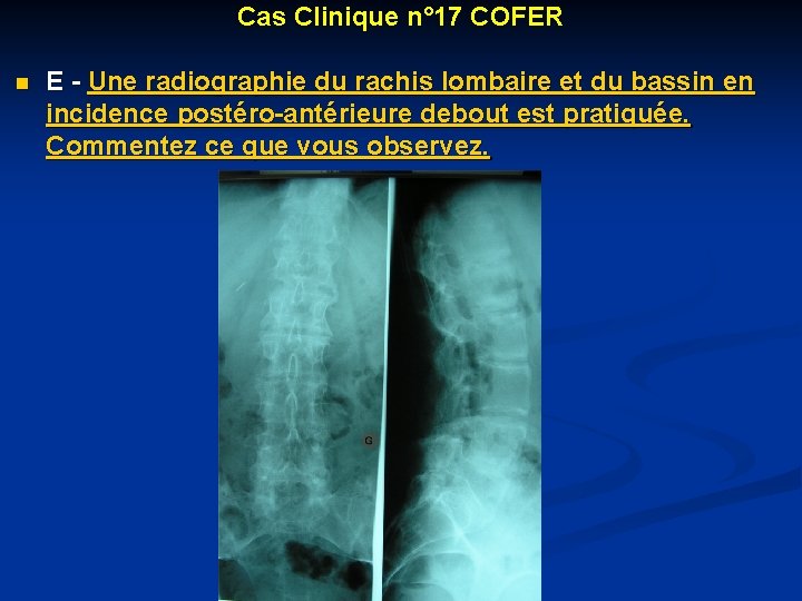 Cas Clinique n° 17 COFER n E - Une radiographie du rachis lombaire et