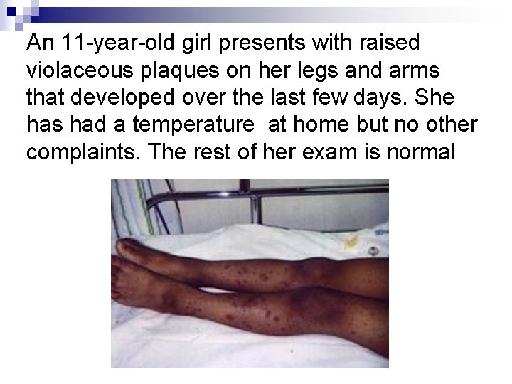An 11 -year-old girl presents with raised violaceous plaques on her legs and arms