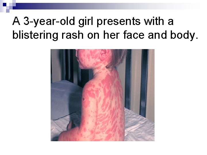 A 3 -year-old girl presents with a blistering rash on her face and body.