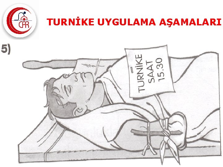 TURNİKE UYGULAMA AŞAMALARI 