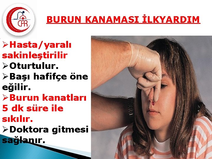 BURUN KANAMASI İLKYARDIM ØHasta/yaralı sakinleştirilir ØOturtulur. ØBaşı hafifçe öne eğilir. ØBurun kanatları 5 dk