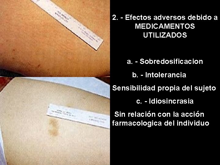 2. - Efectos adversos debido a MEDICAMENTOS UTILIZADOS a. - Sobredosificacion b. - Intolerancia