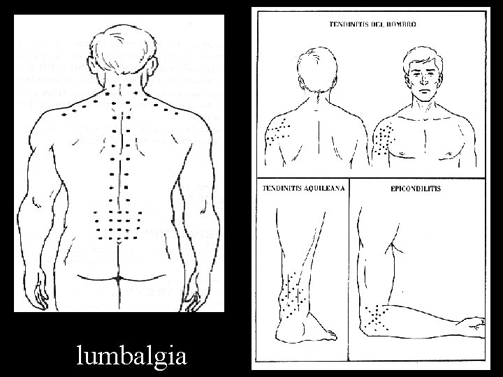 lumbalgia 