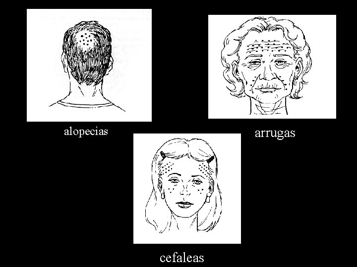 alopecias arrugas cefaleas 