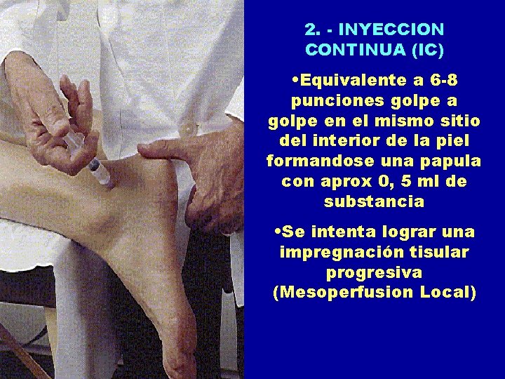 2. - INYECCION CONTINUA (IC) • Equivalente a 6 -8 punciones golpe a golpe