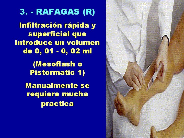 3. - RAFAGAS (R) Infiltración rápida y superficial que introduce un volumen de 0,