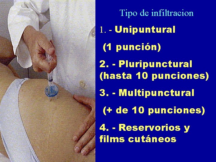 Tipo de infiltracion 1. - Unipuntural (1 punción) 2. - Pluripunctural (hasta 10 punciones)