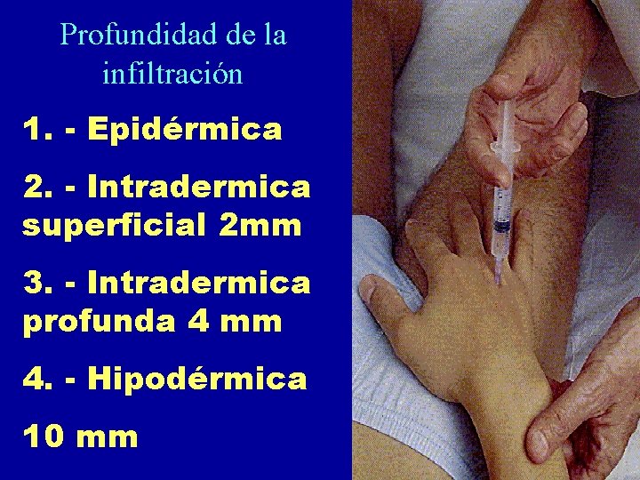 Profundidad de la infiltración 1. - Epidérmica 2. - Intradermica superficial 2 mm 3.