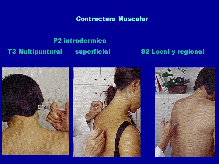 Contractura Muscular P 2 intradermica T 3 Multipuntural superficial S 2 Local y regional