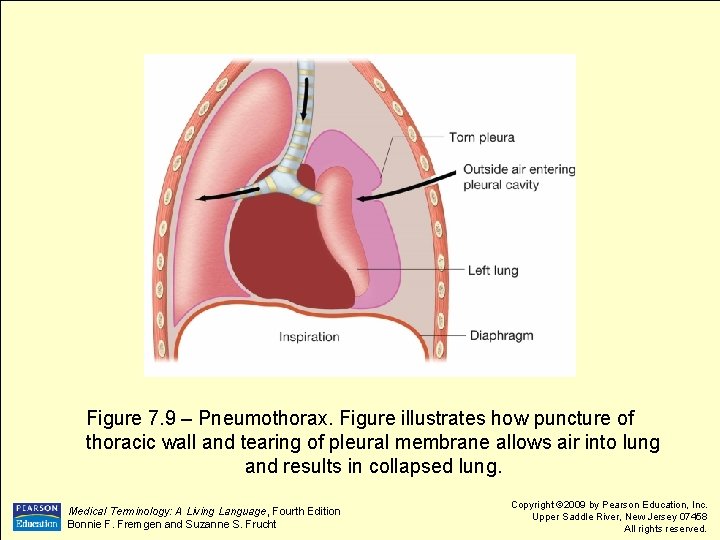 Figure 7. 9 – Pneumothorax. Figure illustrates how puncture of thoracic wall and tearing