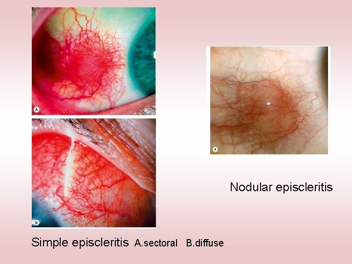 Nodular episcleritis Simple episcleritis A. sectoral B. diffuse 