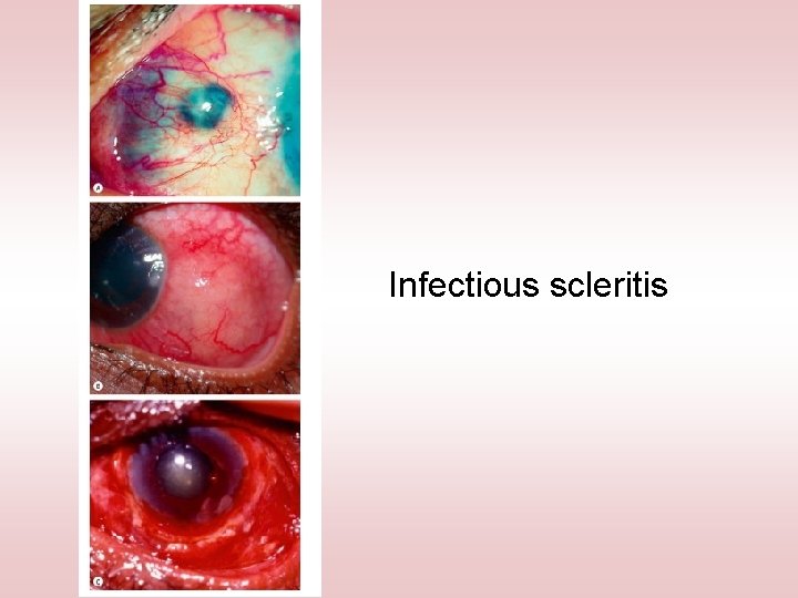 Infectious scleritis 