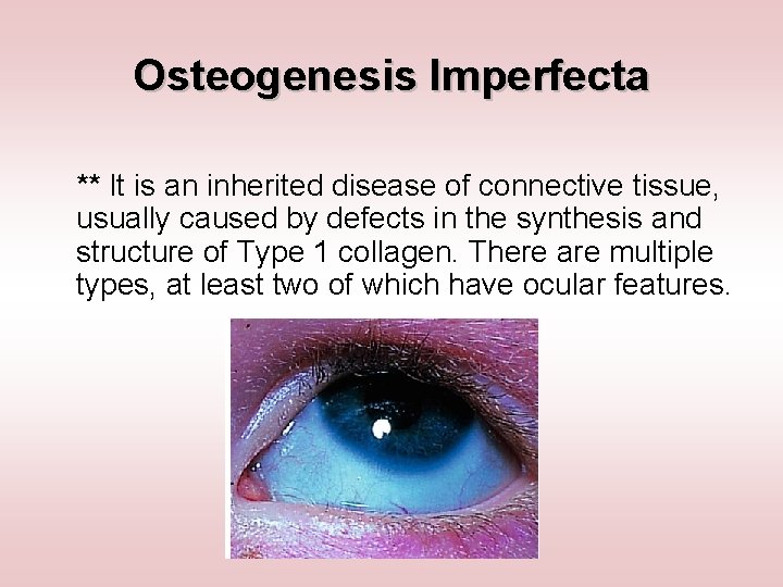 Osteogenesis Imperfecta ** It is an inherited disease of connective tissue, usually caused by