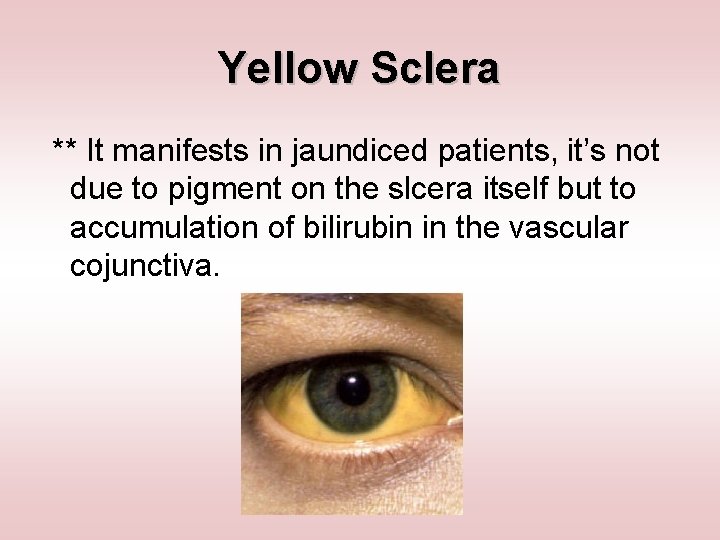 Yellow Sclera ** It manifests in jaundiced patients, it’s not due to pigment on