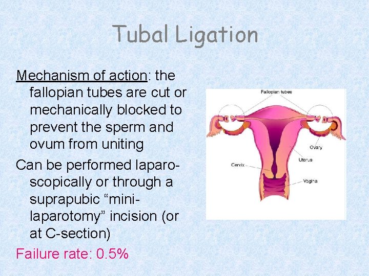 Tubal Ligation Mechanism of action: the fallopian tubes are cut or mechanically blocked to