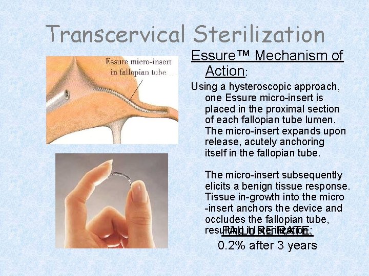 Transcervical Sterilization Essure™ Mechanism of Action: Using a hysteroscopic approach, one Essure micro-insert is