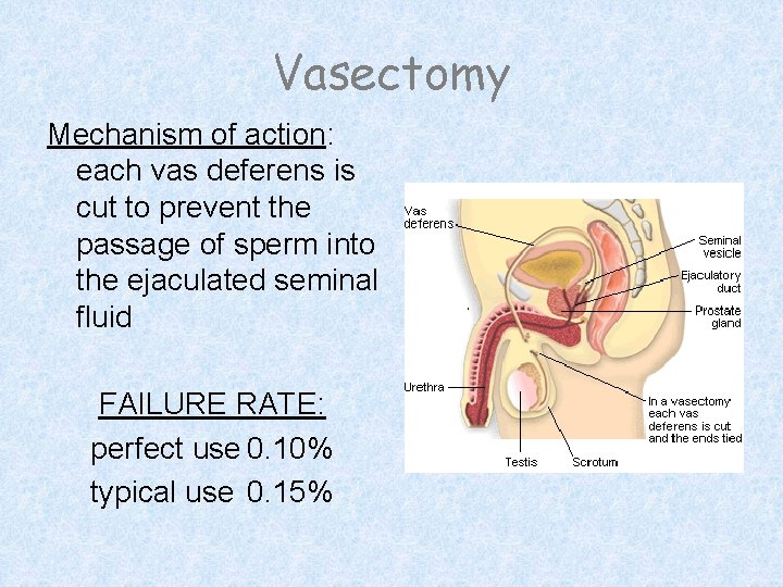 Vasectomy Mechanism of action: each vas deferens is cut to prevent the passage of