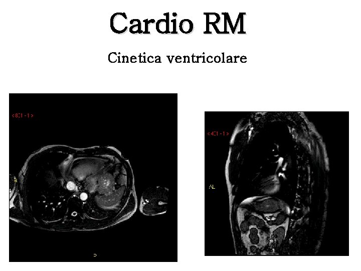 Cardio RM Cinetica ventricolare 