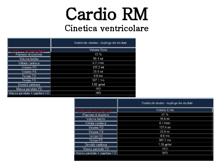 Cardio RM Cinetica ventricolare 