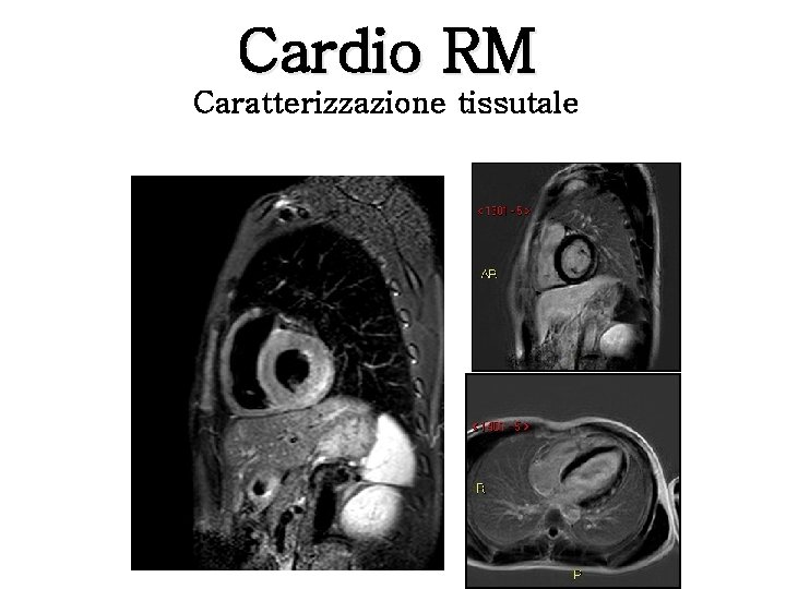 Cardio RM Caratterizzazione tissutale 