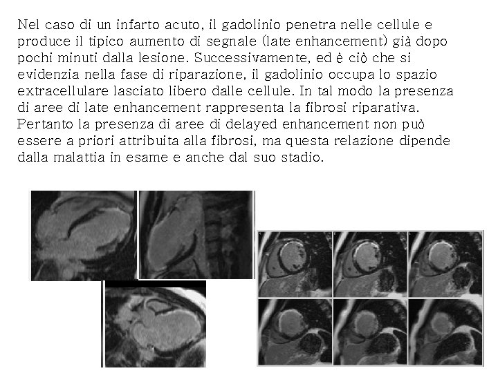 Nel caso di un infarto acuto, il gadolinio penetra nelle cellule e produce il