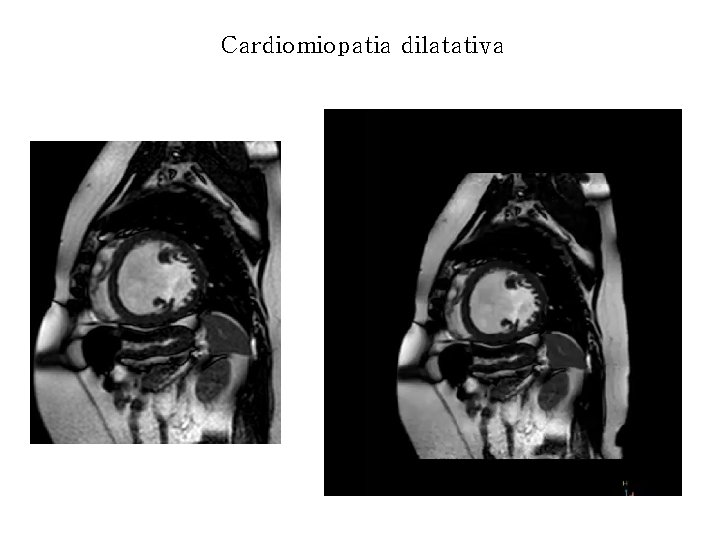 Cardiomiopatia dilatativa 