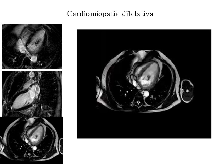 Cardiomiopatia dilatativa 