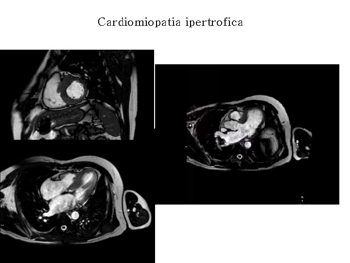 Cardiomiopatia ipertrofica 