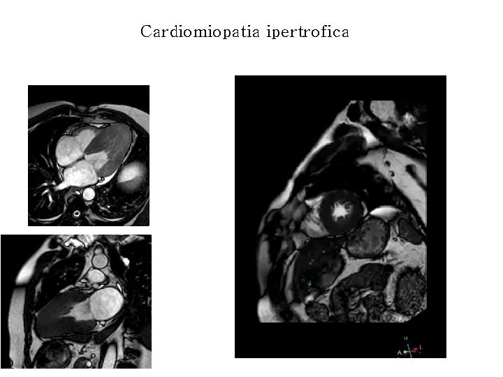 Cardiomiopatia ipertrofica 