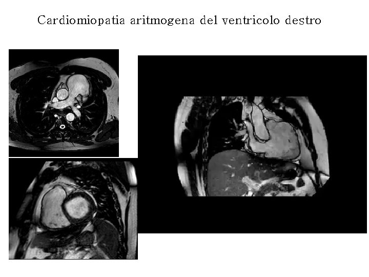 Cardiomiopatia aritmogena del ventricolo destro 