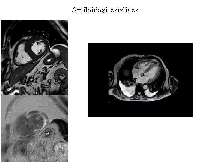 Amiloidosi cardiaca 