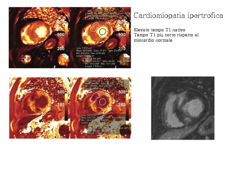 Cardiomiopatia ipertrofica Elevato tempo T 1 nativo Tempo T 1 più corto rispetto al