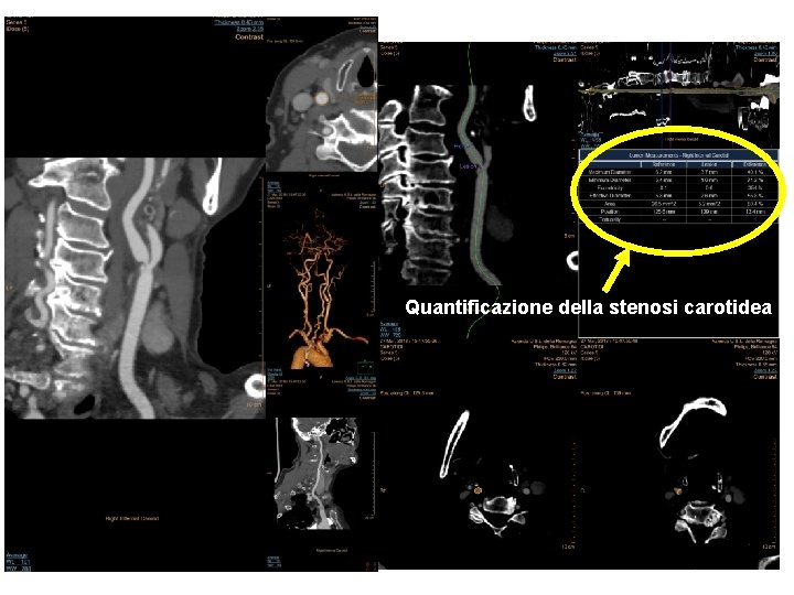 Quantificazione della stenosi carotidea 